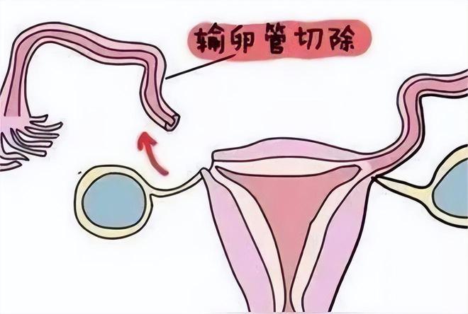 海外试管助孕